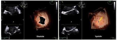 Functional Tricuspid Regurgitation: Behind the Scenes of a Long-Time Neglected Disease